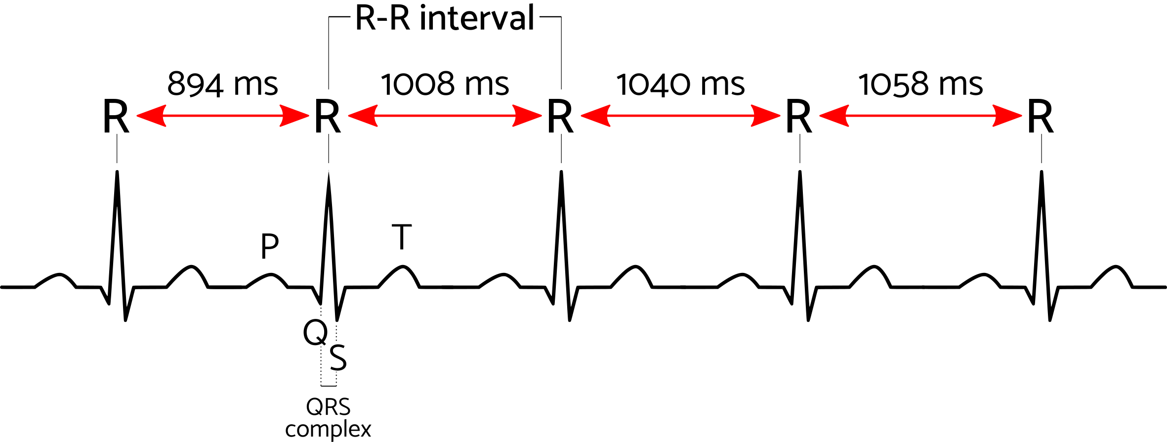 An electrocardiogram showing the QRS complex where the time between the R peaks represents and R-R or interbeat interval